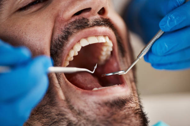 Best Emergency Dental Care for Broken or Chipped Teeth in South Lebanon, OH