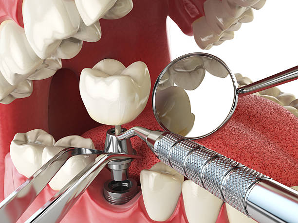 Best Urgent Care for Lost Fillings or Crowns in South Lebanon, OH